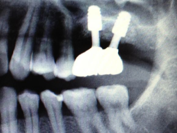 8年経ったインプラント治療！