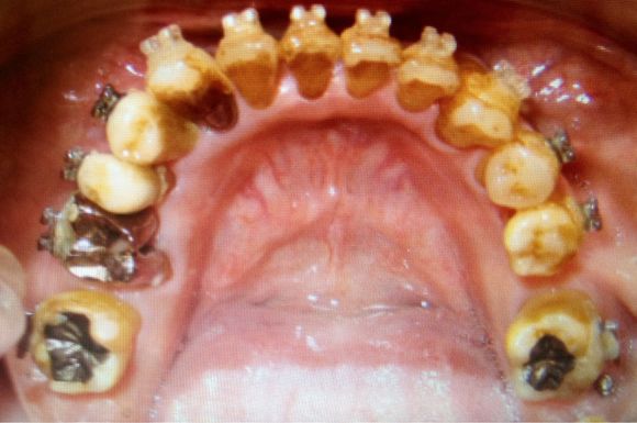 歯周病 、歯槽膿漏は、噛み合わせ、歯並びが原因？