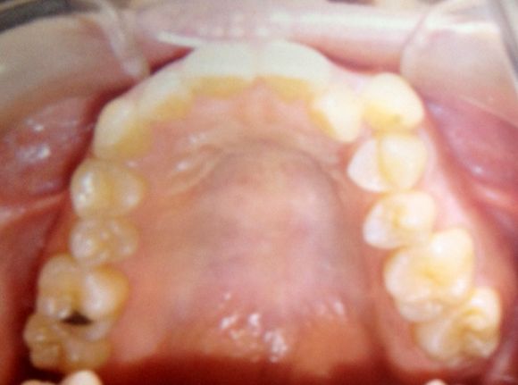 八重歯 糸切り歯は、歯を抜かずに！