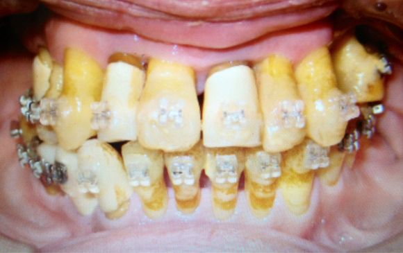 歯周病 、歯槽膿漏は、噛み合わせ、歯並びが原因？